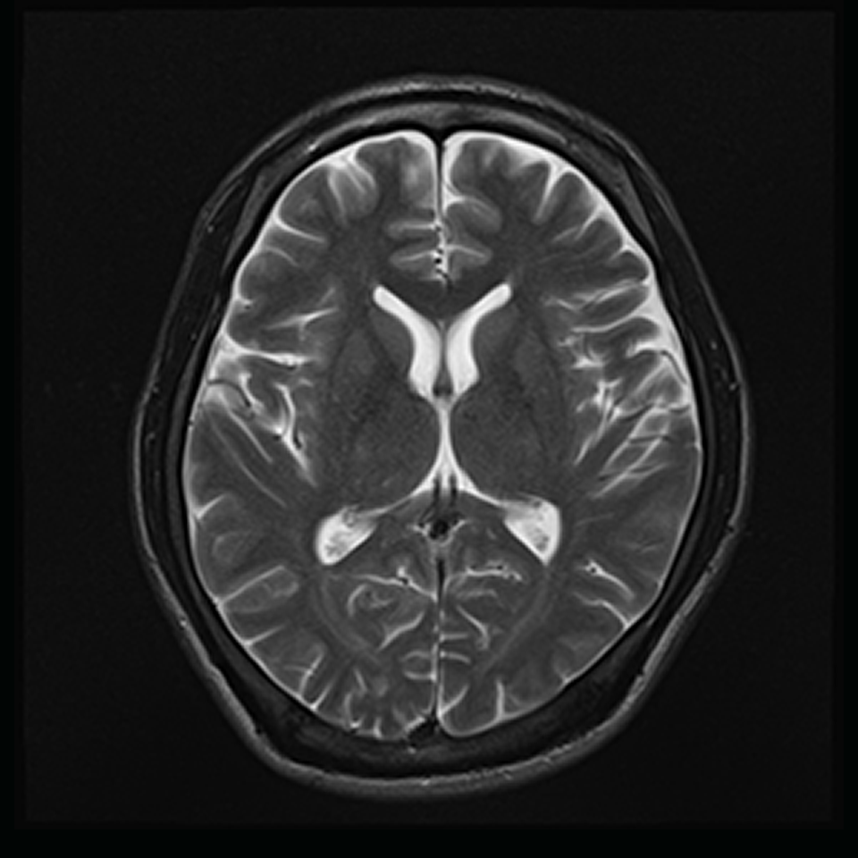 MRI画像でアルツハイマー型認知症を早期発見する脳萎縮評価支援システム