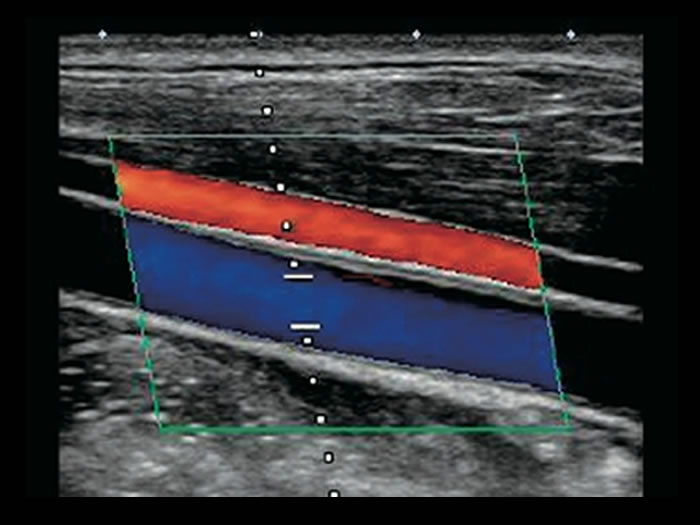 頸部（首）の超音波検査の画像