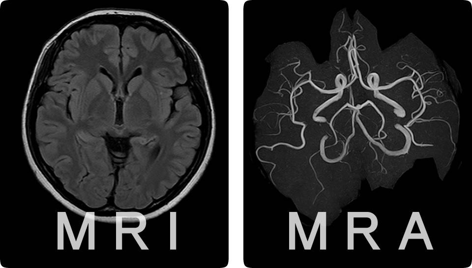 MRI検査画像とMRA検査画像の比較