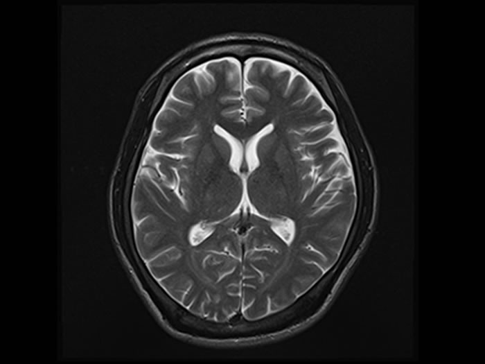 MRI検査による脳の委縮画像