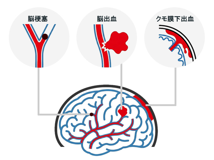 3タイプの脳卒中「脳梗塞」「脳出血」「クモ膜下出血」の特徴を示した図
